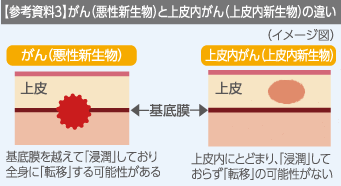 参考資料3 がんと上皮内がんの違い