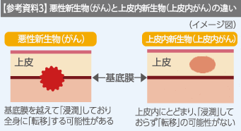 参考資料3 がんと上皮内がんの違い