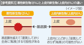 参考資料3　がんと上皮内がんの違い